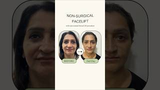 2nd Day Results of NonSurgical Facelift See the Transformation [upl. by Marten]