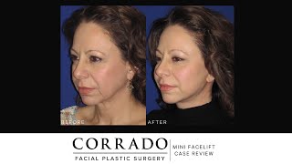 Mini Facelift Before and After Pictures  Dr Anthony Corrado [upl. by Piggy]