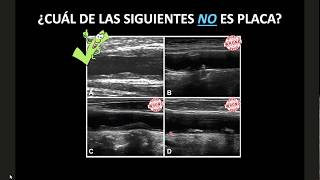 DOPPLER CAROTIDEO  PARTE II [upl. by Cioffred]