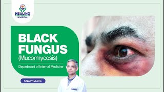 Black Fungus Mucormycosis  Causes Symptoms Treatment amp Prevention  Healing Hospital Chandigarh [upl. by Blatman]