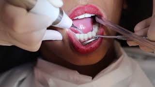 How teeth cleaning is done   DENTAL SCALING  FMS DENTAL HOSPITALS [upl. by Elawalo]