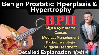 BPH Benign Prostatic Hperplasia and Hypertrophy in Hindi  Prostate Enlargement causes amp treatment [upl. by Anniala308]