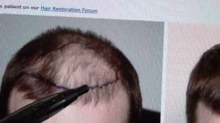 Hair Transplant Primer 2015 [upl. by Scott]