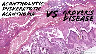 Acantholytic Dyskeratotic Acanthoma vs Grovers Disease 5Minute Pathology Pearls [upl. by Anivle]