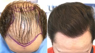 FUE Hair Transplant REPAIR 3000 Grafts Norwood V By Dr Juan Couto  FUEXPERT CLINIC Madrid Spain [upl. by Aisiat]