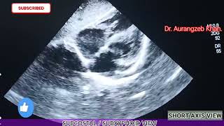 Echocardiographic Views  Part 1  The Subcostal Long And Short Axis Views [upl. by Ydnes]