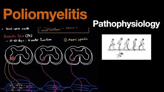 Poliomyelitis amp PostPolio Syndrome  Pathophysiology [upl. by Ataga]