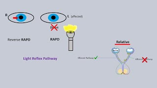 RAPD eye test  relative afferent pupillary defect  Marcus gunn pupil [upl. by Yrrak]