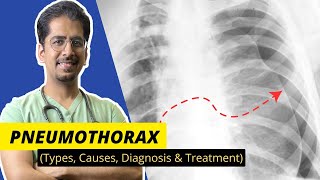 PNEUMOTHORAX Types Causes Diagnosis amp Treatment  Detailed video [upl. by Nemzaj]