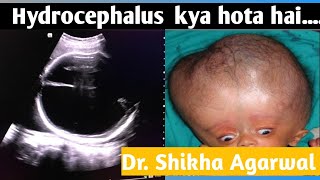 Hydrocephalus बच्चे के सिर में पानी जमा होनाbirthdefectDr Shikha AgarwalHydrocephalus क्या है [upl. by Dotson]