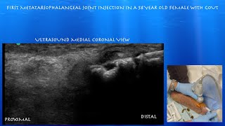 Ultrasound Guided First Metatarsophalangeal Joint Injection by probeultrasound [upl. by Ammeg]