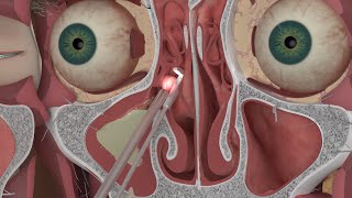 Chapter 3 Nasal and Sinus Problems and Solutions [upl. by Helsa]