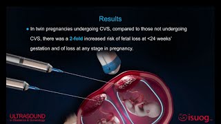 UOG video abstract on chorionic villus sampling in twin pregnancy [upl. by Anneis269]