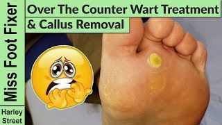 Over the counter Wart Treatments VS Miss Foot Fixer Wart Treatment part one [upl. by Ahsiki]