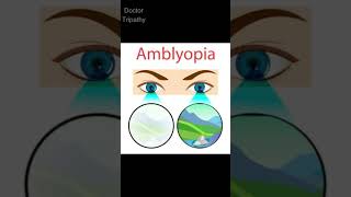 Amblyopia  Common Eye Diseases  eyes amblyopia eyedisease eyediseases shorts opthalmology [upl. by Pollak894]