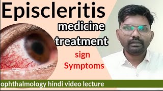 Episcleritis treatment  Episcleritis disease in eye  sclera anatomy  Episcleritis  optometry [upl. by Cyrus]