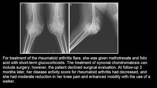 Synoviale Chondromatose [upl. by Ilise]