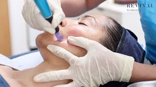 Microneedling Full Training Video [upl. by Comyns]