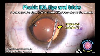 CataractCoach™ 2282 phakic IOL tips tricks [upl. by Hayward]