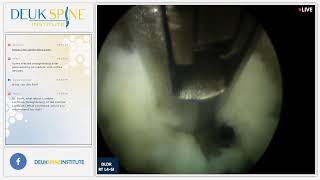 Watch Live Back Treatment Deuk Laser Disc Repair  Lumbar  RT L4S1 [upl. by Eboj]