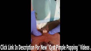 Huge Cyst In Knee GRAPHIC [upl. by Nette]