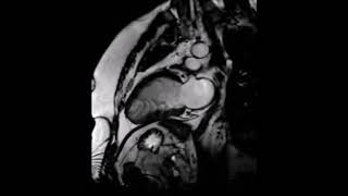 Heart MRI Scans  Leeds General Infirmary [upl. by Hasan]