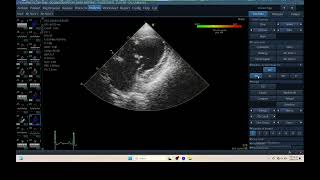 IQ 306 TSI TISSUE SYNCHRONY IMAGING ECHOPAC ANALYSIS ECHOCARDIOGRAPHY HEPATOMA PTE [upl. by Nipha]