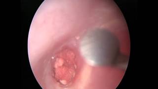 Endoscopic tympanoplasty mediumsized perforation微創中耳炎手術 [upl. by Breban414]