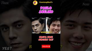 Paulo Avelino nagparetoke Ng ilong [upl. by Cerelly]