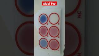 Widal Test for Typhoid and Paratyphoid Fever Salmonella Typhi and Salmonella Paratyphi [upl. by Arammat610]