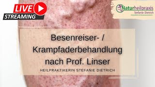 Sanfte Saline Besenreiser amp Krampfaderbehandlung nach Prof Linser  ambulant  Heilpraktiker [upl. by Malissa]