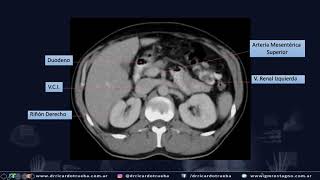 TOMOGRAFIA AXIAL BASICA DE ABDOMEN Y PELVIS [upl. by Amlez]