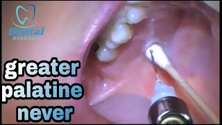 greater palatine nerve injection  شرح نظرى و عملى [upl. by Rawdan]