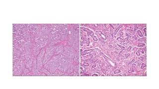 Sertoli leydig cell tumorGYNpath [upl. by Yee91]