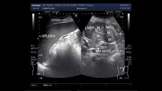 Ultrasound Video showing hepatic parenchymal disease with multiple masses and splenomegaly [upl. by Ferrand]