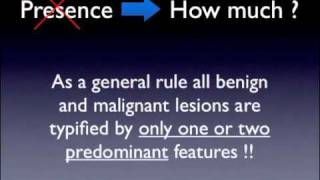 Melanoma criteria 13 by Dr Giuseppe Argenziano [upl. by Kernan119]