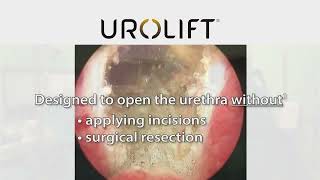 UroLift™ System Treatment [upl. by Nylirehc]