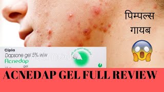 ACNEDAP GEL FULL REVIEW BEST FOR ACNE AND PIMPLE [upl. by Underwood400]