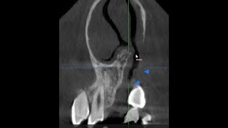 ALVEOLAR CLEFT CBCT BASICS OF INTERPRETATION [upl. by Brenden334]