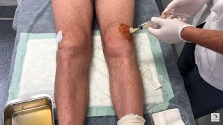 Knee effusion and arthrocentesis Swollen knee English version [upl. by Urbai]