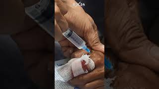 local anesthetic injection  anesthesia technique  Lidocaine 2 [upl. by Miarfe]