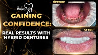 Gaining Confidence Real Results with Hybrid Dentures [upl. by Anglim]