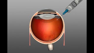 Spritze ins Auge  bei AMD diabetischem Makulaödem retinalen Gefäßverschlüssen [upl. by Llegna]