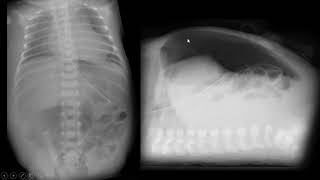 Pneumoperitônio neonatal [upl. by Otsuaf]