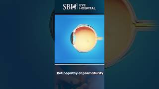 What is retinopathy of prematurity  Retinopathy of prematurity  Eye Treatment  SBH Hospital [upl. by Wellesley456]