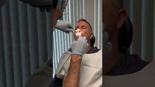 Nasal splint removal one week after Septoplasty [upl. by Nonnaer]