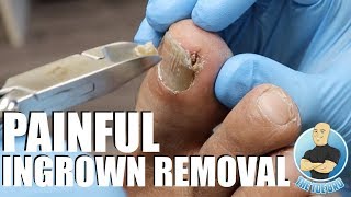 TREATING AN EXTREMELY PAINFUL INGROWN TOENAIL WITH HOW TO ADVICE [upl. by Setarcos]