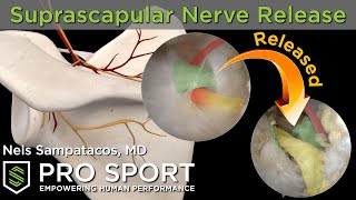 Arthroscopic Suprascapular Nerve Release real surgery  animations [upl. by Mandell]