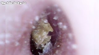 Ear Wax Removal 163 Small ear canal but lots of wax  Dry and itchy earwax  Ear Cleaning ASMR [upl. by Roon333]