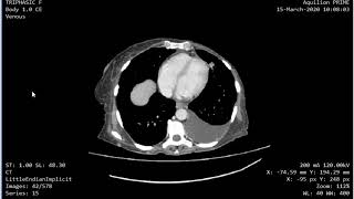 CASE 922 CT TRIPHASIC LIVER CIRRHOSIS HEPATIC METASTSES [upl. by Aneram]